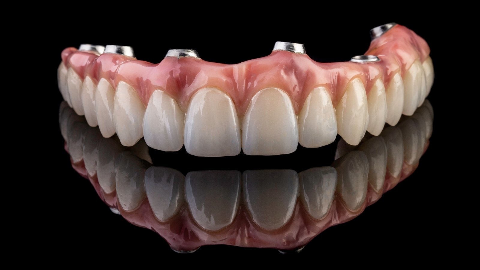 bridge dentaire sur implants
