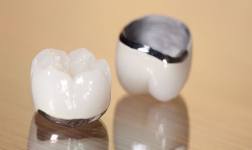 couronne ceramo metallique algerie alger