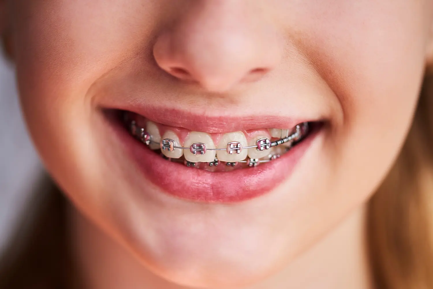 orthodontie enfants algerie alger